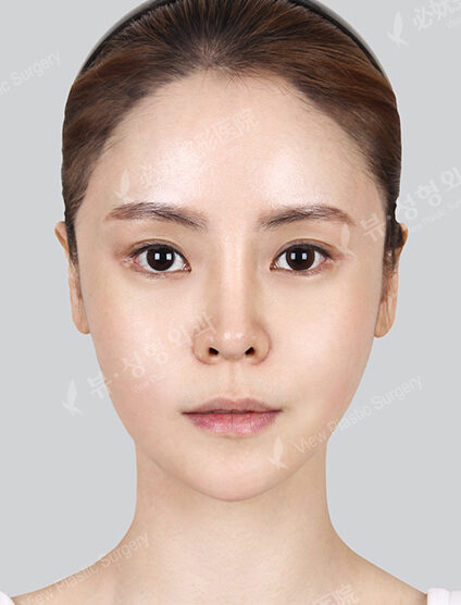 Zygoma Reduction (12 Months) — After