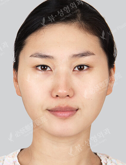 Natural Vline+Zygoma Reduction+Forehead Implant+Revisional Eye Surgery (3 Months) — Before