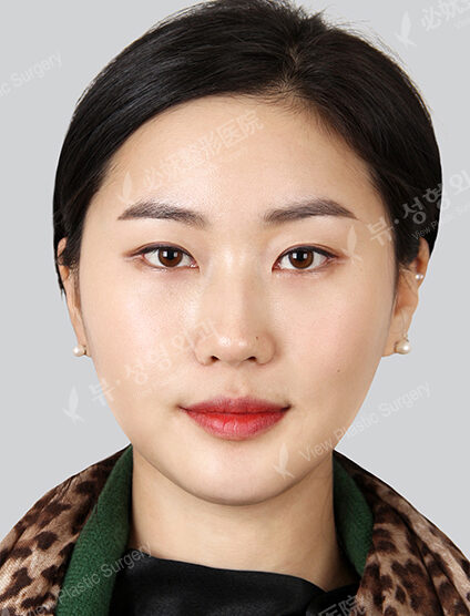 Natural Vline+Zygoma Reduction+Forehead Implant+Revisional Eye Surgery (3 Months) — After