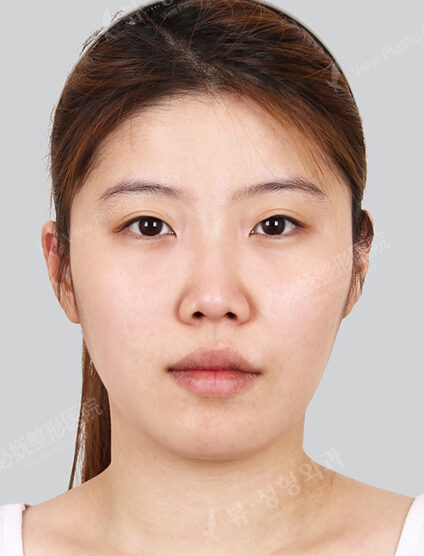 Natural Vline+Zygoma Reduction+Rhinoplasty+Eye Surgery+Forehead Implant+PA (7 Months) — Before