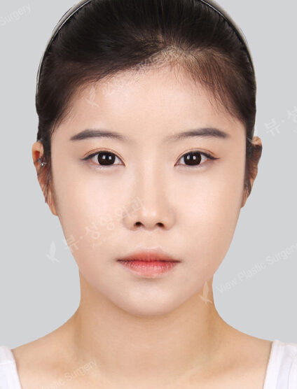 Natural Vline+Zygoma Reduction+Rhinoplasty+Eye Surgery+Forehead Implant+PA (7 Months) — After