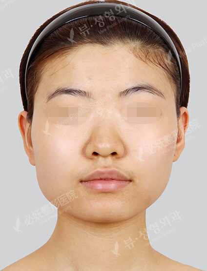 Natural Vline+Zygoma Reduction (3 Months) — Before