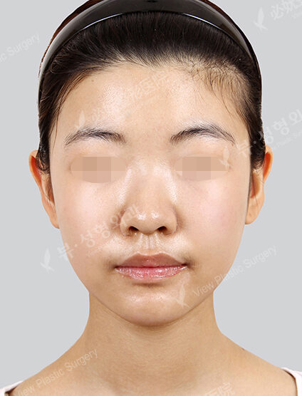 Natural Vline+Zygoma Reduction (3 Months) — After