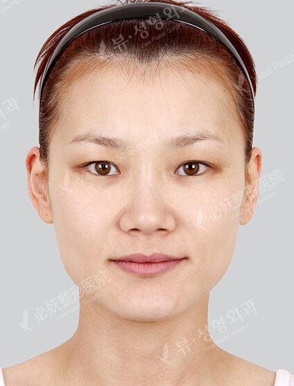 Doll Line (Vline)+ Zygoma Reduction+Frontal Cheek Implant+Face Fat Graft+Rhinoplasty+Fat Graft (1 Months) — Before