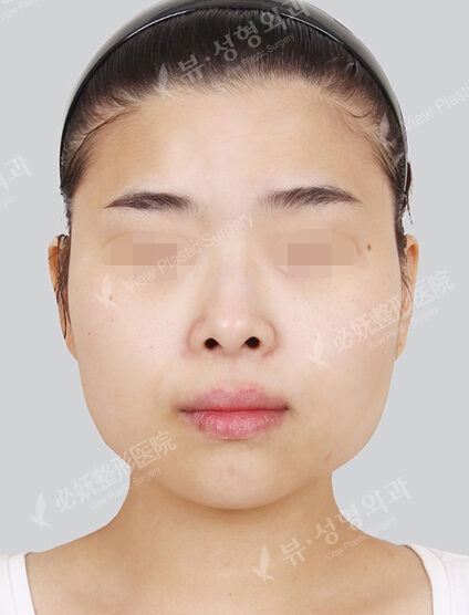Natural Vline+Zygoma Reduction (3 Months ) — Before