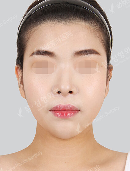 Natural Vline+Zygoma Reduction (3 Months ) — After