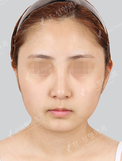 Natural Vline (6 Months) — Before