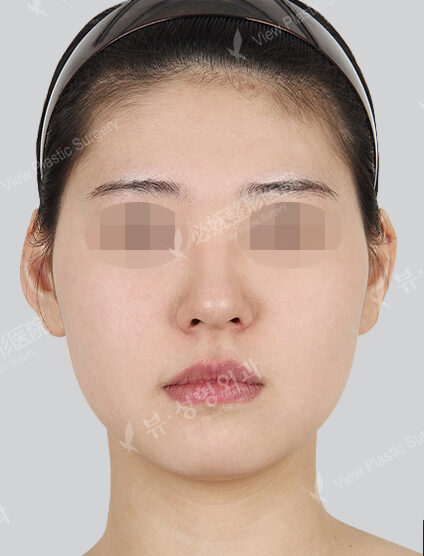 Natural Vline+Zygoma Reduction+Fat Graft (Forehead , Nasolabial)+ Acculifting (14 Months) — Before