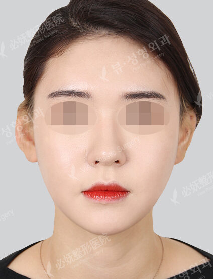 Natural Vline+Zygoma Reduction+Fat Graft (Forehead , Nasolabial)+ Acculifting (14 Months) — After