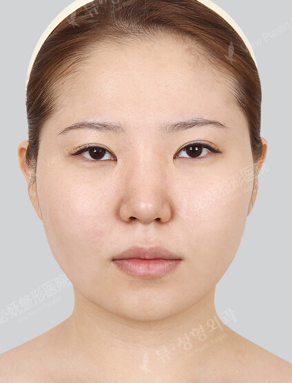 Natural Vline+Zygoma Reduction+Forehead Implant (6 Months) — Before