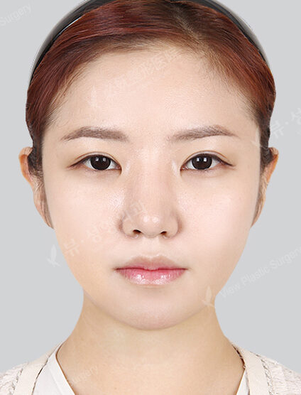 Natural Vline+Zygoma Reduction+Forehead Implant (6 Months) — After
