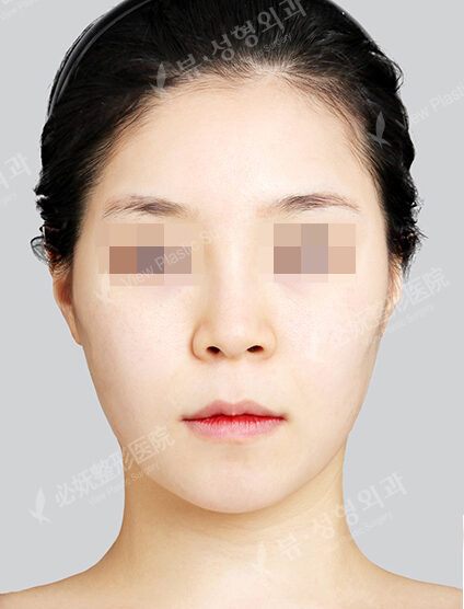Doll Line (Vline)+ Zygoma Reduction (3 Months) — Before