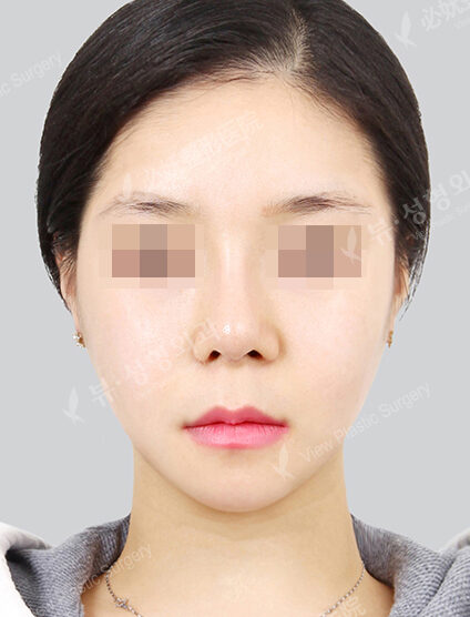 Doll Line (Vline)+ Zygoma Reduction (3 Months) — After