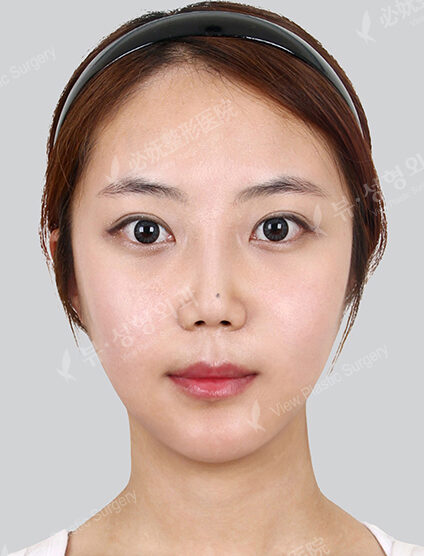 Natural Vline+Zygoma Reduction+PA+Forehead , Frontal Cheeks Fat Graft+Rhinoplasty+Fat Graft (1 Months) — After