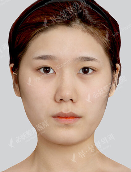 Natural Vline+Zygoma Reduction+Forehead Implant (3 Months) — Before