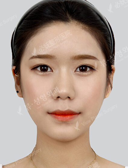 Natural Vline+Zygoma Reduction+Forehead Implant (3 Months) — After