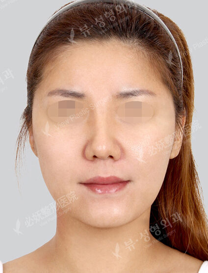 Natural Vline+Zygoma Reduction+PA+Forehead Implant (2 Months) — Before