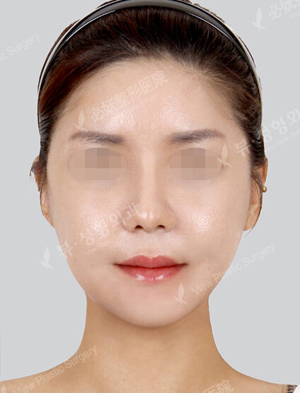 Natural Vline+Zygoma Reduction+PA+Forehead Implant (2 Months) — After
