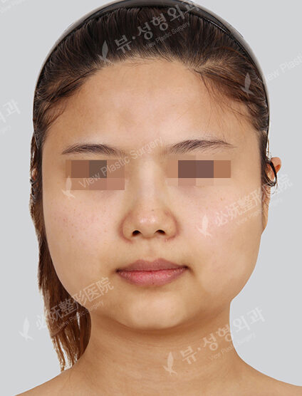 Natural Vline+Zygoma Reduction+Forehead Implant(4 Months) — Before