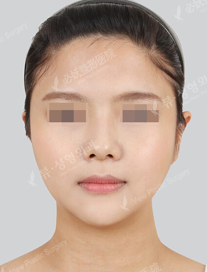 Natural Vline+Zygoma Reduction+Forehead Implant(4 Months) — After