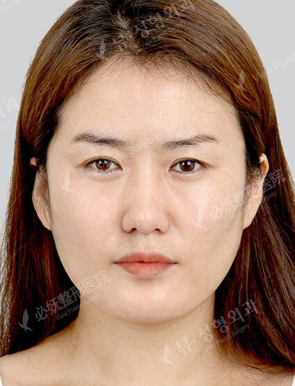 Natural Vline+Zygoma Reduction+Rhinoplasty+PA (3 Months) — Before