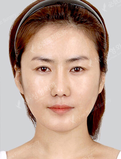Natural Vline+Zygoma Reduction+Rhinoplasty+PA (3 Months) — After