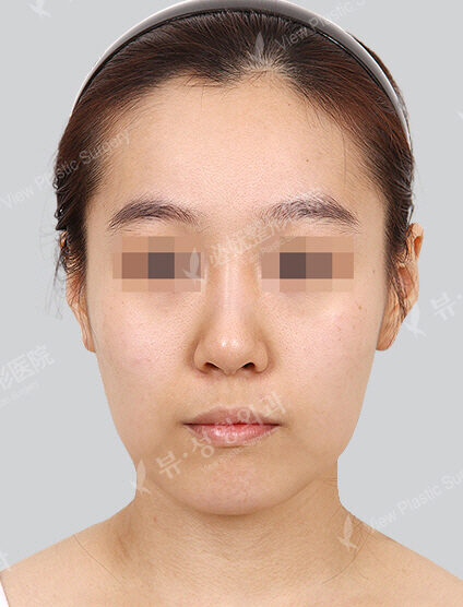 Natural Vline+Zygoma Reduction(1 Months) — Before