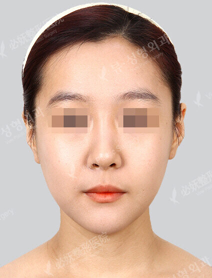 Natural Vline+Zygoma Reduction(1 Months) — After