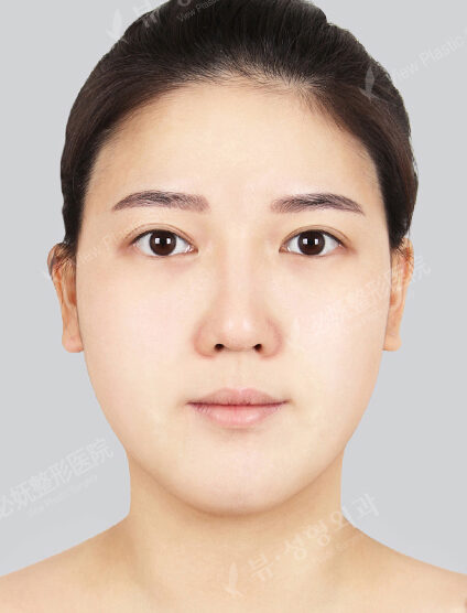 Doll Line (Vline)+ Zygoma Reduction+Lifting+Rhinoplasty+Fat Graft (5 Months) — Before