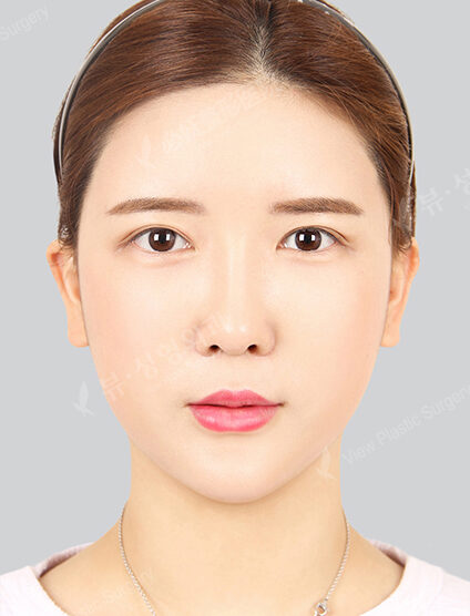 Doll Line (Vline)+ Zygoma Reduction+Lifting+Rhinoplasty+Fat Graft (5 Months) — After