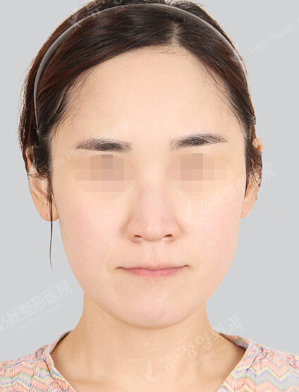 Doll Line (Vline)+ Zygoma Reduction+Acculifting+Rhinoplasty (11 Months) — Before