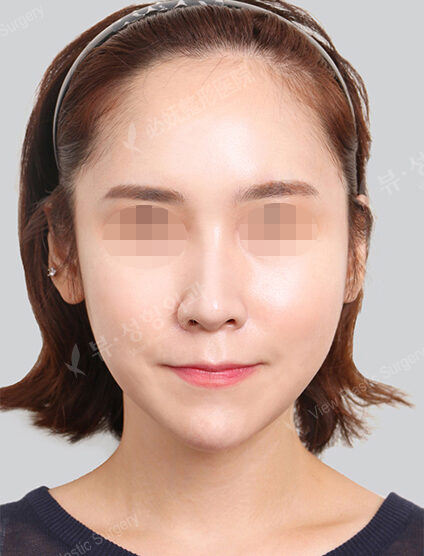 Doll Line (Vline)+ Zygoma Reduction+Acculifting+Rhinoplasty (11 Months) — After