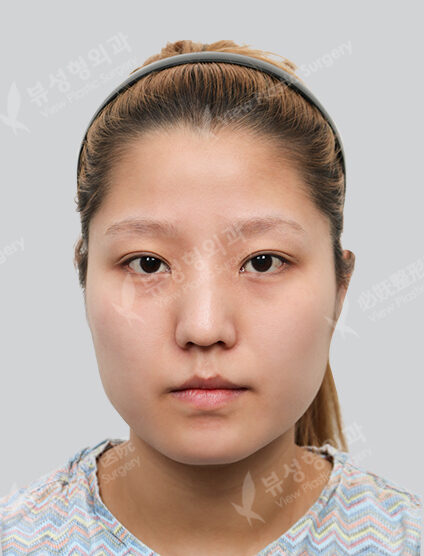 (Cheekbone+Angular Jaw+Chin Tip)+ Low Nose (14 Months) — Before