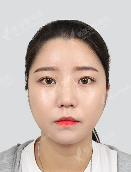 (Cheekbone+Angular Jaw+Chin Tip)+ Low Nose (14 Months) — After
