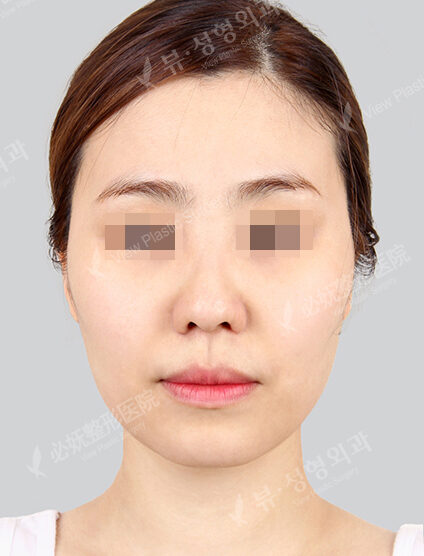 Natural Vline+Zygoma Reduction (4 Months) — Before