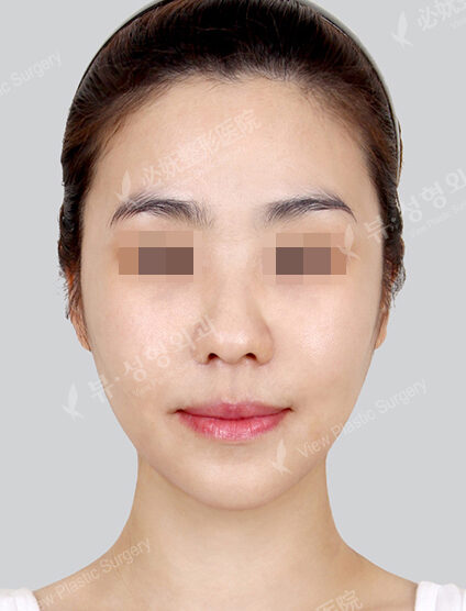 Natural Vline+Zygoma Reduction (4 Months) — After