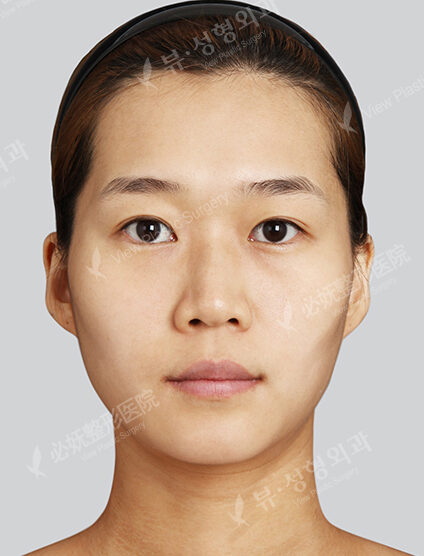 Natural Vline+Zygoma Reduction+Forehead Implant+Anterior Cheekbones Implant +PA+Rhinoplasty (3 Months) — Before