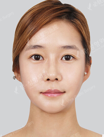 Natural Vline+Zygoma Reduction+Forehead Implant+Anterior Cheekbones Implant +PA+Rhinoplasty (3 Months) — After