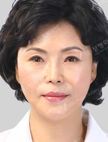 Angular Jaw+Zygoma Reduction+Front Chin (Revisional Surgery)+ Rhinoplasty+Fat Graft (5 Months) — After