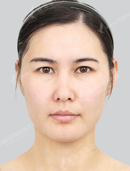 Natural Vline+Zygoma Reduction+Burial method+Rhinoplasty (4 Months) — Before