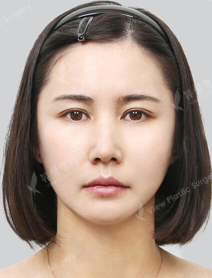 Natural Vline+Zygoma Reduction+Burial method+Rhinoplasty (4 Months) — After