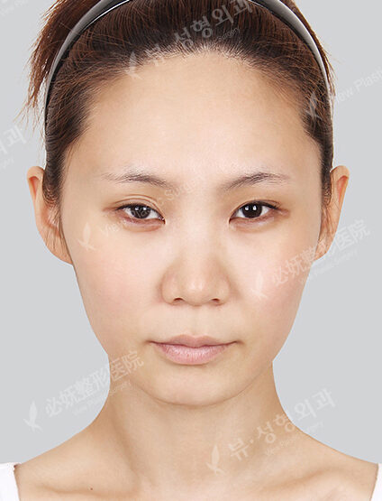 Doll Line (Vline)+ Zygoma Reduction+Forehead Fat Graft+PA+Combination Ptosis Correction Surgery+Rhinoplasty (6 Months) — Before