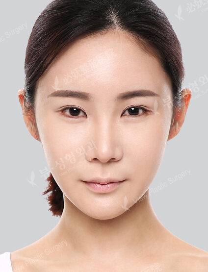 Doll Line (Vline)+ Zygoma Reduction+Forehead Fat Graft+PA+Combination Ptosis Correction Surgery+Rhinoplasty (6 Months) — After
