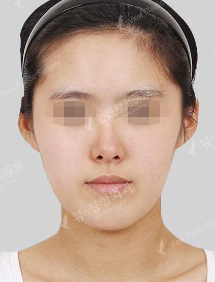 Natural Vline+Zygoma Reduction+Angular Jaw Reduction+Combination Ptosis Correction Surgery+Frontal Cheek Implant+PA(4 Months) — Before
