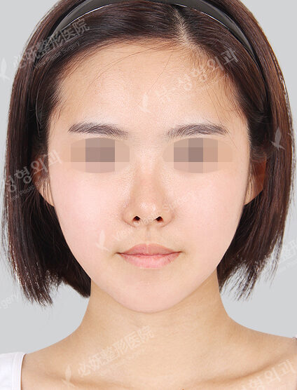 Natural Vline+Zygoma Reduction+Angular Jaw Reduction+Combination Ptosis Correction Surgery+Frontal Cheek Implant+PA(4 Months) — After