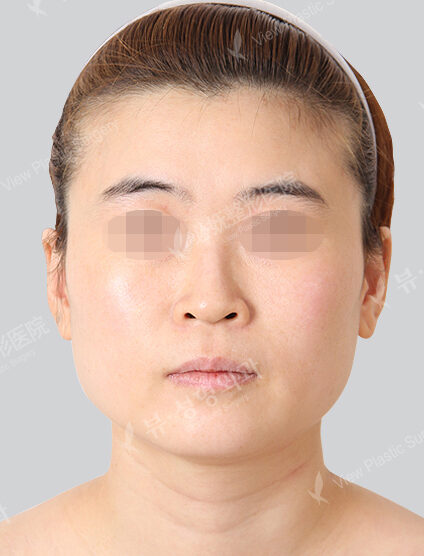 Natural Vline+Genioplasty+Rhinoplasty (6 Months) — Before