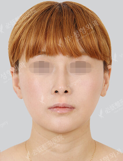 Natural Vline+Genioplasty+Rhinoplasty (6 Months) — After