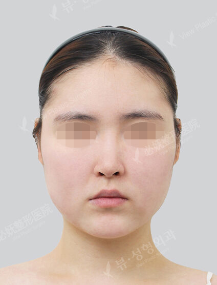 Natural Vline+Zygoma Reduction+Thread Lifting+Acculifting (10 Months) — Before