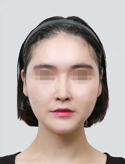 Natural Vline+Zygoma Reduction+Thread Lifting+Acculifting (10 Months) — After
