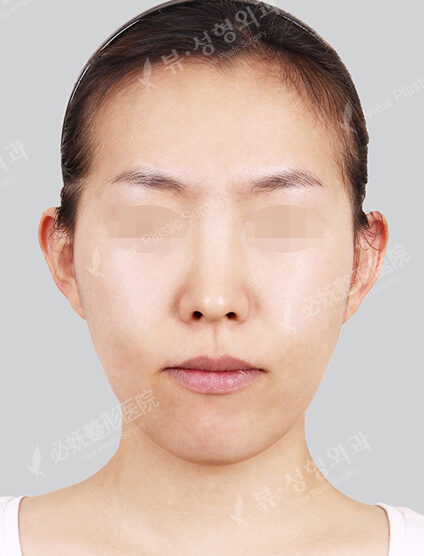 Natural Vline+Zygoma Reduction (3 Months) — Before